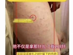 美女扎腿間(山東一女生，被同桌男生用錐子在腿上扎成了馬蜂窩)