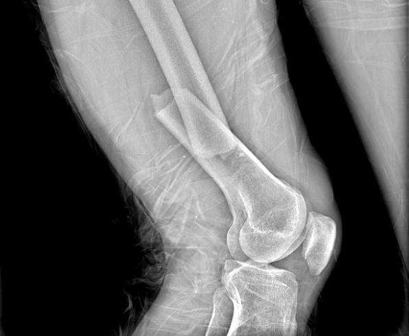 小切口治療股骨干骨折，讓意外傷無“微”不治