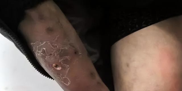 “丫丫”到底怎么了？骨瘦如柴、毛發(fā)脫落 → 網(wǎng)友：像吸毒了一樣！